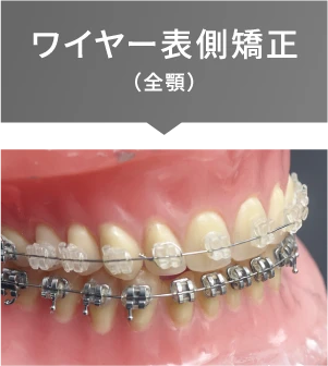 ワイヤー表型矯正（全顎）