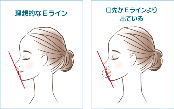 口先がEラインより出ている