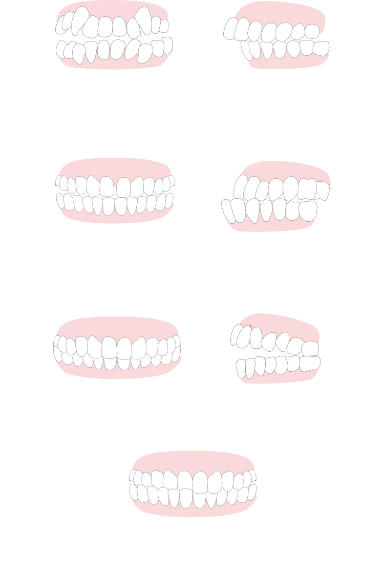 いろいろな歯並び